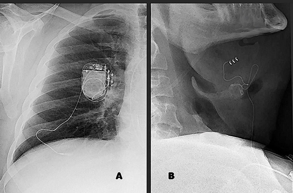 Hypoglossal nerve stimulation device in place, with components in the chest and neck